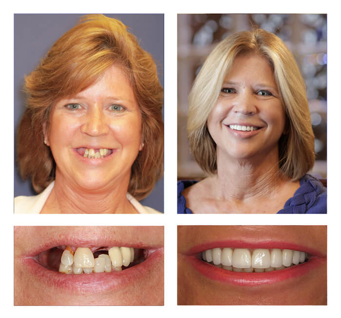Michelle teeth next day® before and after photos 
