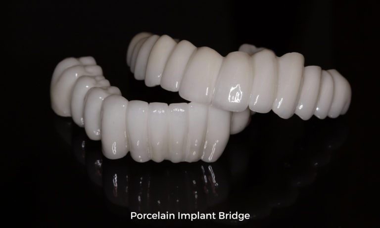 porcelain implant bridge