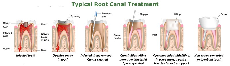 typical root canal treatment
