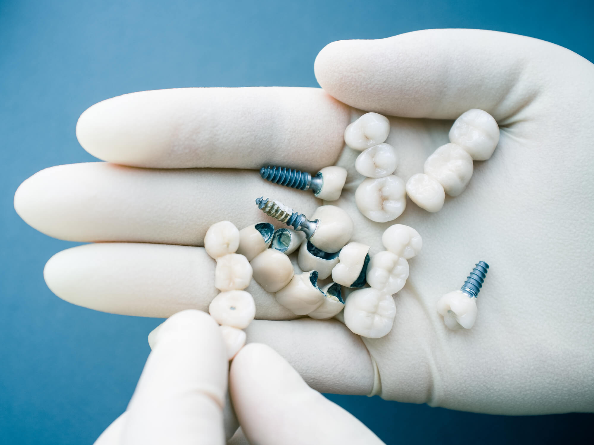 Dental Implants Vs. Dentures: Which One Is Right For You