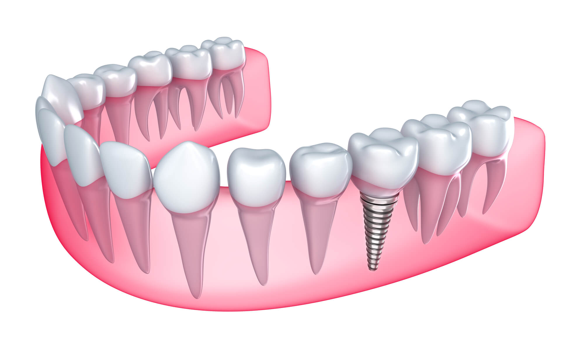 Advantages Of Dental Implants