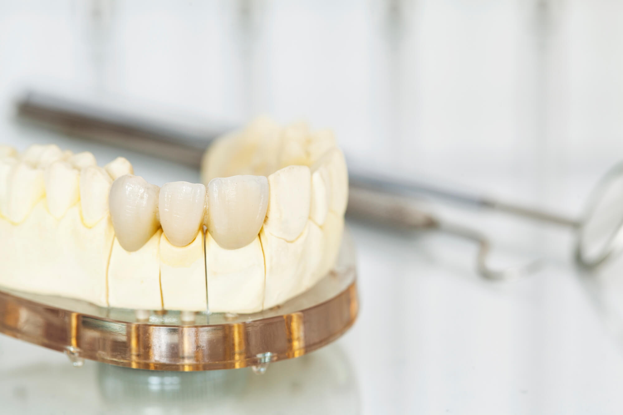 Why Choose Implant-Supported Bridges For Missing Teeth