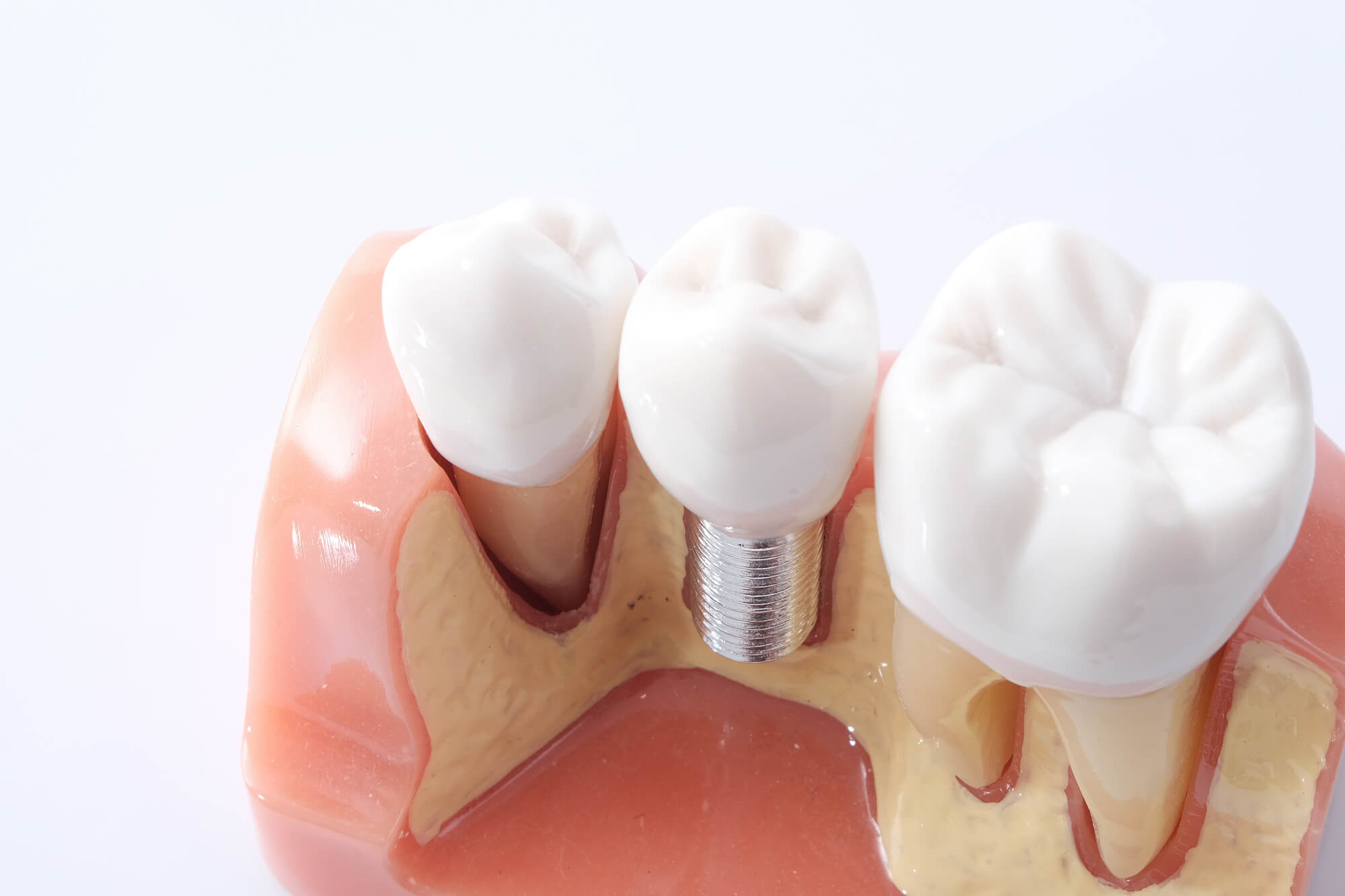 Are There Age Restrictions For Getting Dental Implants