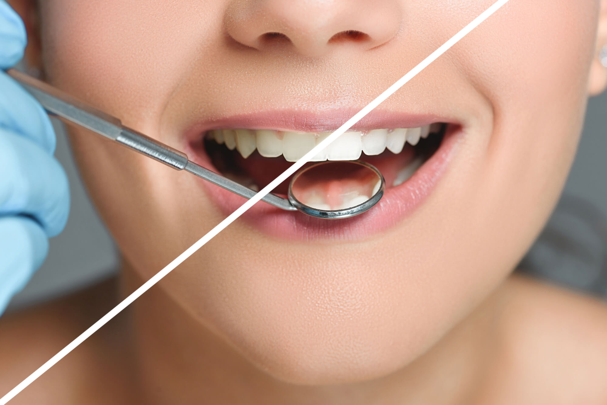 The Science Of Tooth Whitening