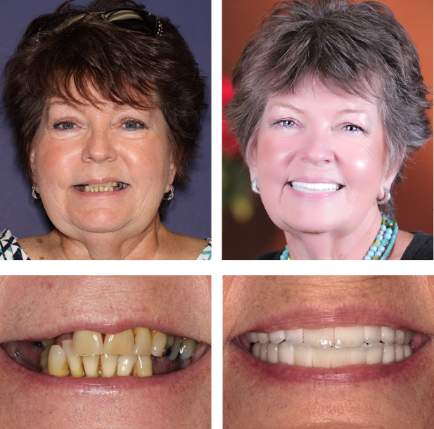 Linda teeth next day® before and after photos