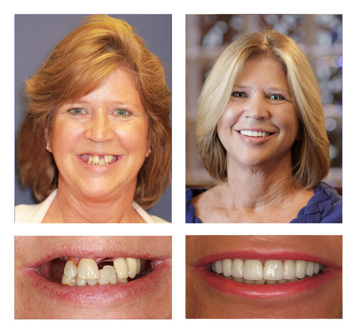 Michelle teeth next day® before and after photos