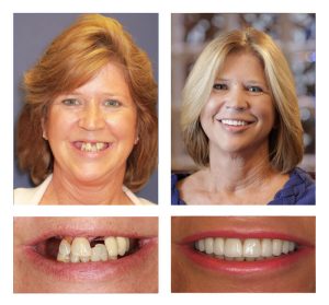 before and after dental treatment at Vero Dental Spa