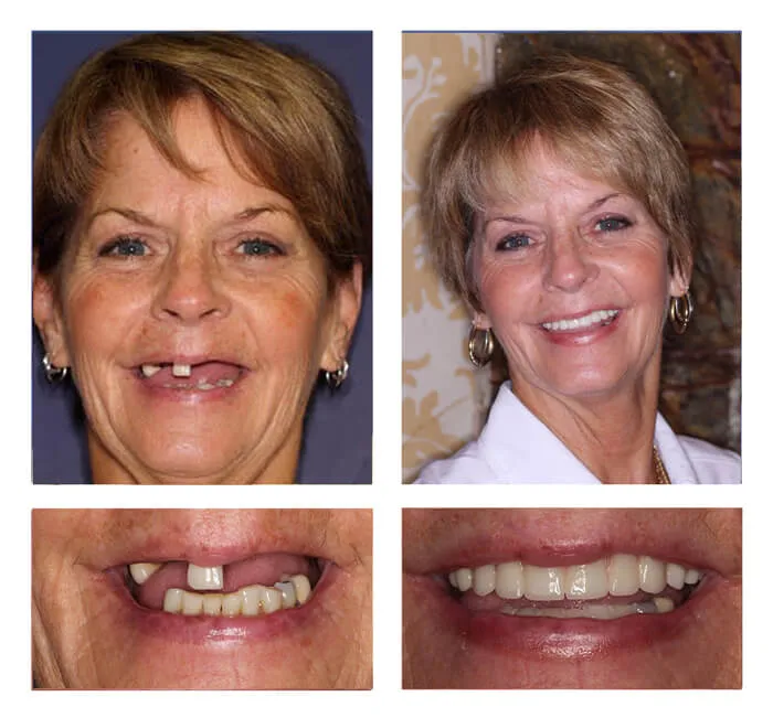 Dental Bridges