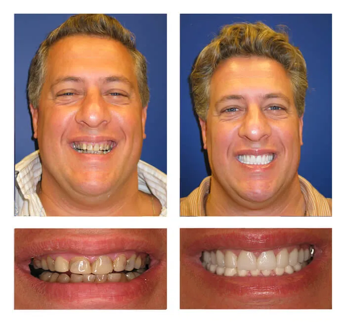 Teeth Whitening