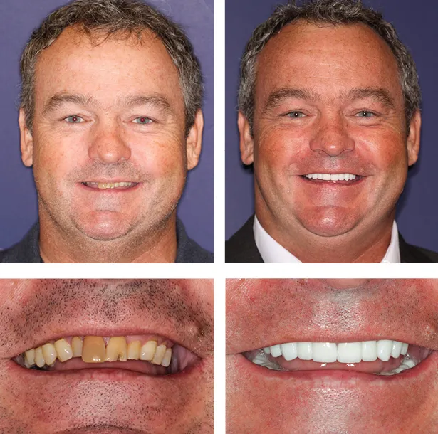 before and after dental treatment at Vero Dental Spa