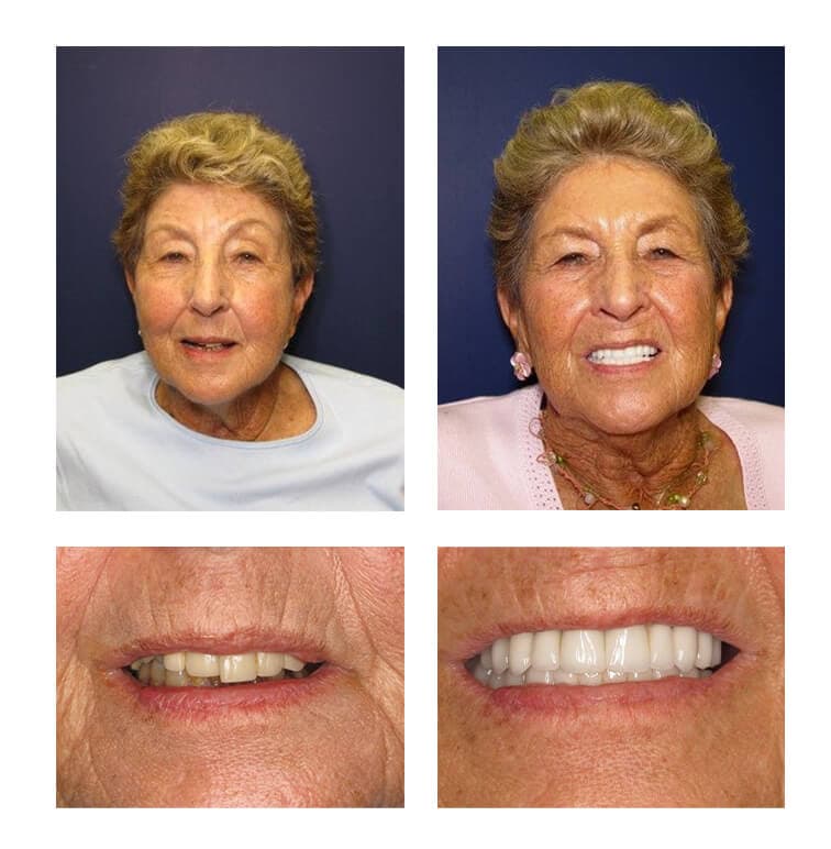 Bone Grafting and Soft Tissue Augmentation Vero Beach, Florida