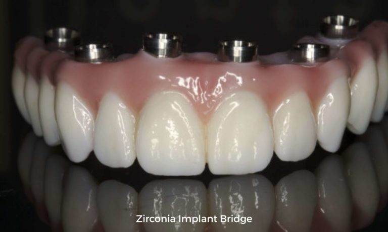 zirconia implant bridge