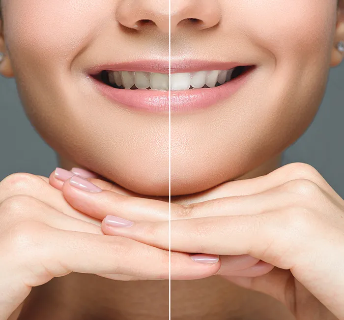 Teeth Whitening