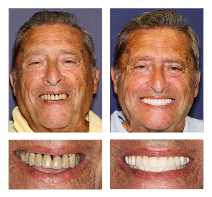 Why Choose Dental Implants Over Bridges And Dentures