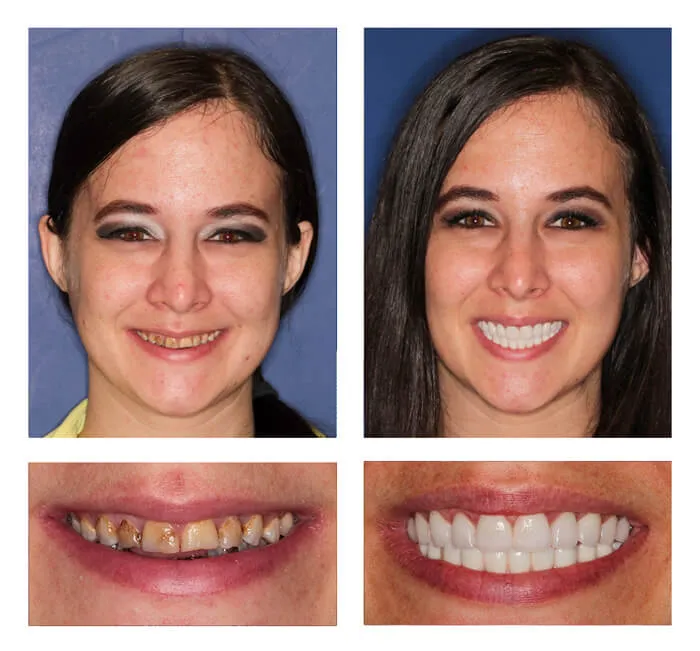 teeth next day® zirconia implant bridge
