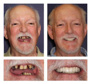 Osseointegration