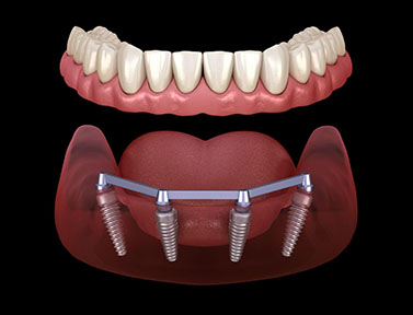 bar-overdenture