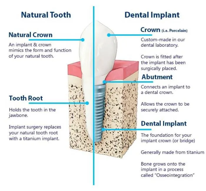 Natural Tooth | Dental Implant