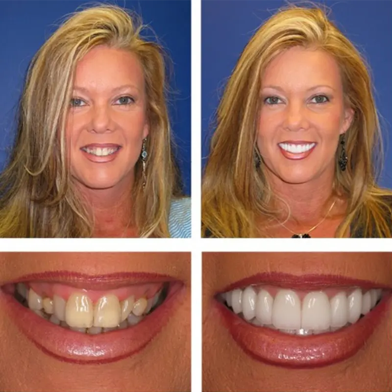 Dental Implants doctor