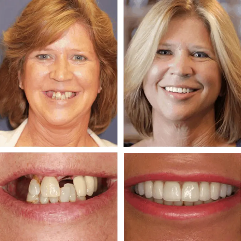 Dental Implants