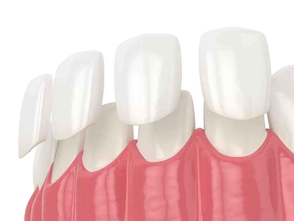 image of porcelain veneers vero beach attached to enamel