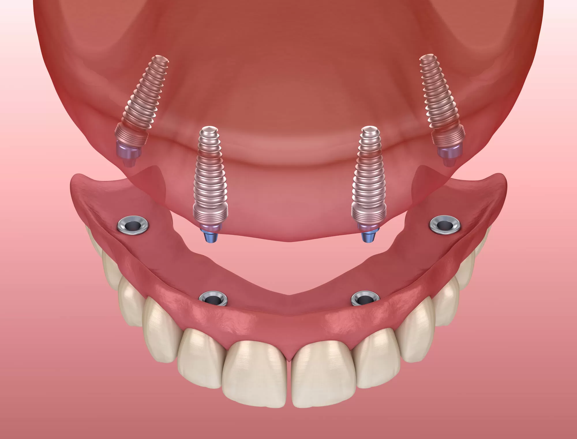 3D image of all on four dental implants in vero beach