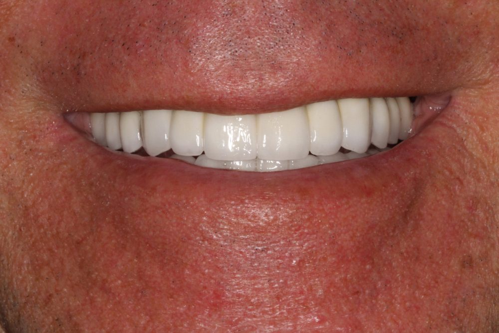 After image