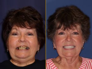 before and after dental treatment at Vero Dental Spa