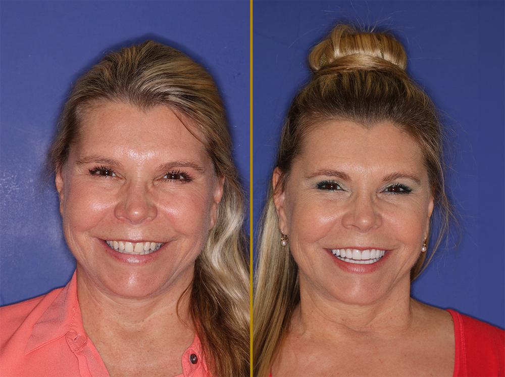 before and after cosmetic dental work in Vero Beach, FL