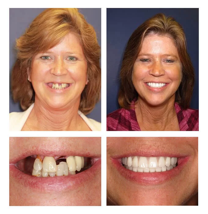 A collage of before and after photos of a female patient of Vera Dental Spa.