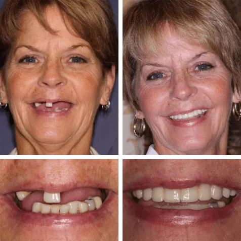 Teeth Next Day® from Vera Dental Spa